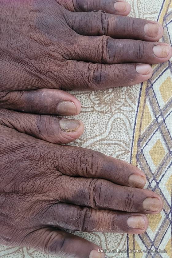 Psoriasis after treatment